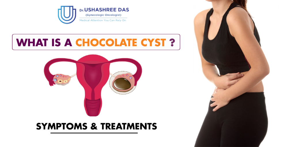 ovarian cancer specialist Bhubaneswar