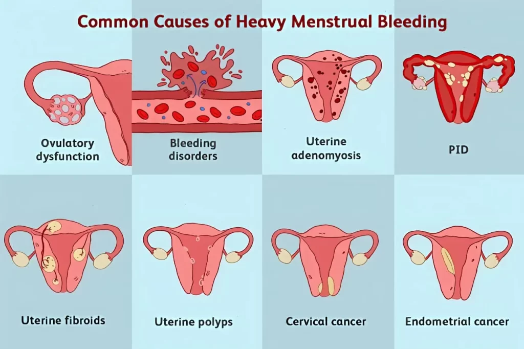 Common Causes of Heavy Menstrual Bleeding