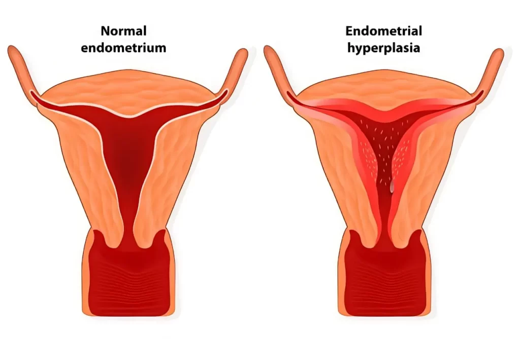Normal Endometrium vs Endometrial Hyperplasia