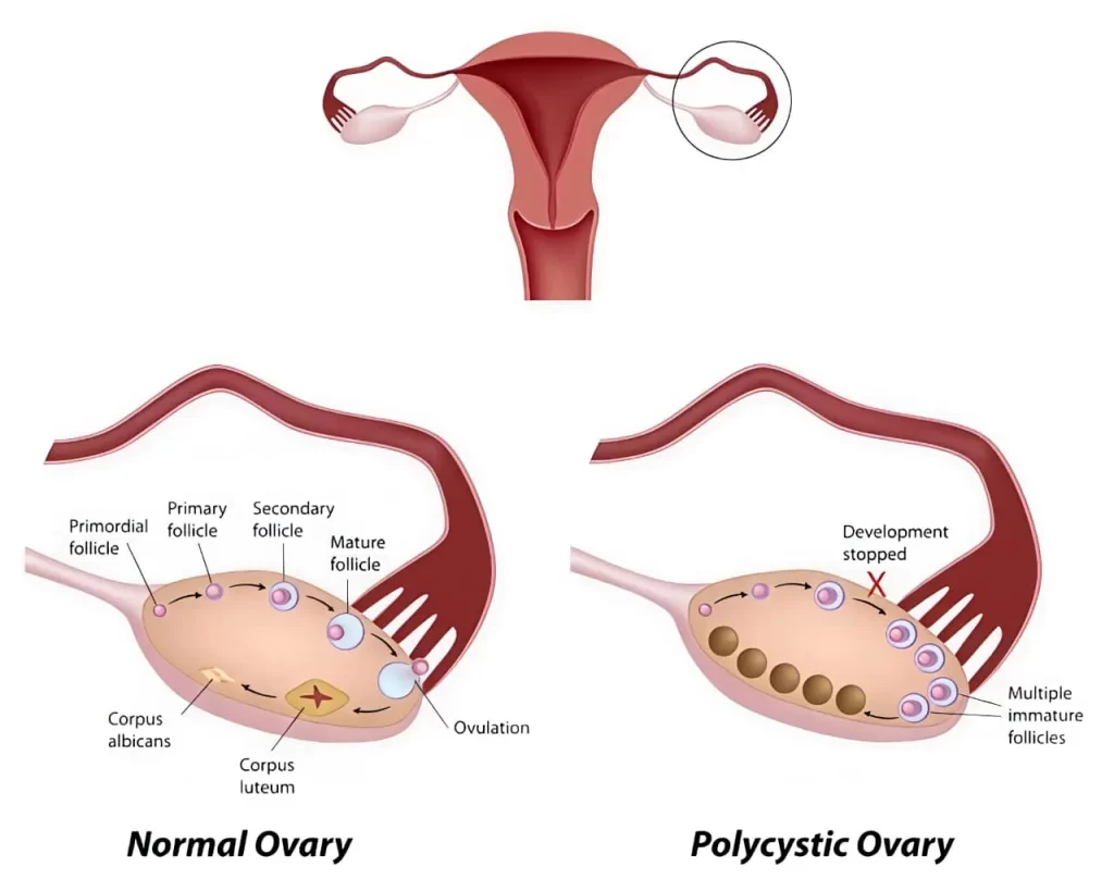 Normal Ovary vs Polycystic Ovary (PCOS)