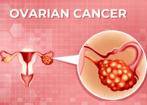 Home 26 Ovarian Cancer Stages 1-4 - Featured Image
