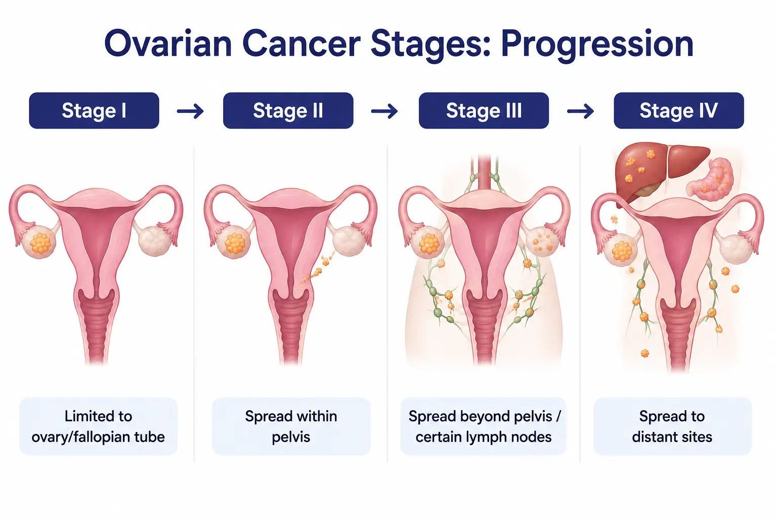 Ovarian cancer stages progession