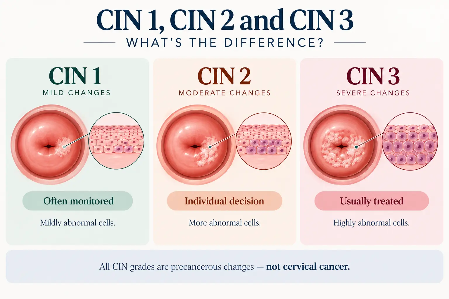 Infographic of CIN 1, CIN 2 and CIN 3 cervical cell changes labelled mild, moderate and severe, with often monitored, individual decision and usually treated