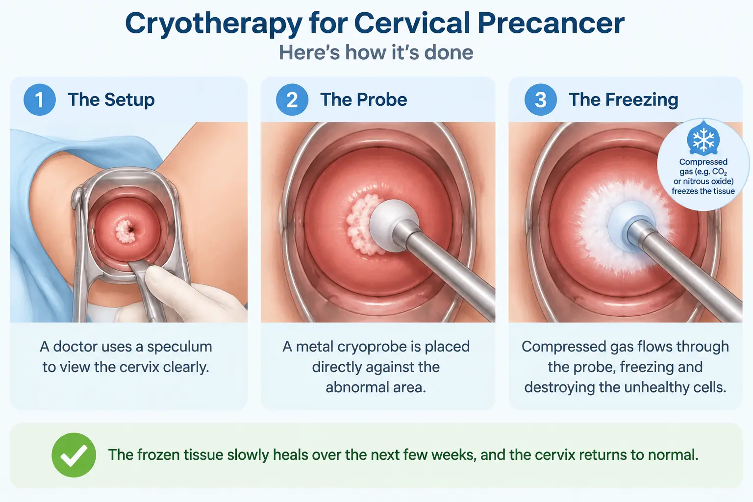Three step illustration of cryotherapy: speculum placed, cryoprobe on the abnormal area, compressed gas freezing the tissue