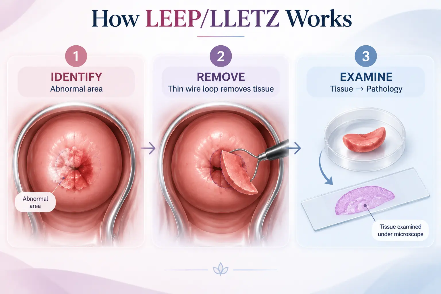 Three step illustration of LEEP/LLETZ: identify the abnormal area, remove it with a thin wire loop, examine the tissue under a microscope