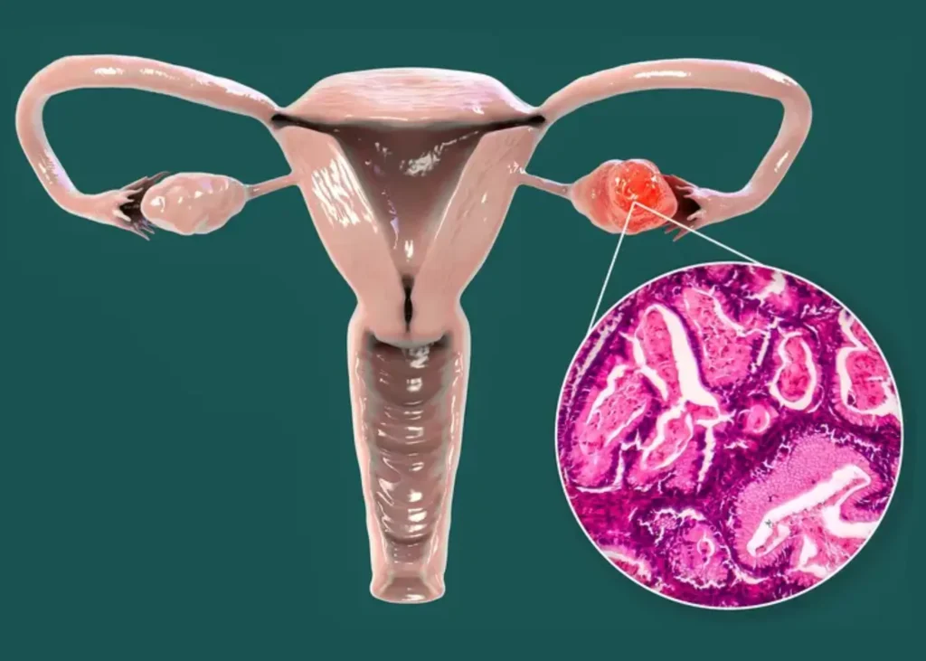 Stage 4 Ovarian Cancer